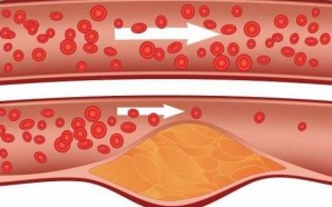 arteria-grasa-obesidad-