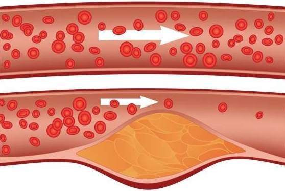 arteria-grasa-obesidad-